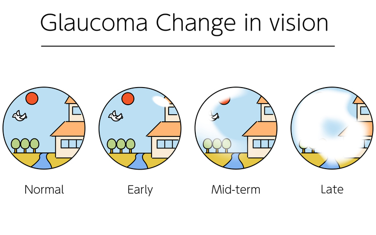 Glaucoma Change in Vision  | Dittman Eyecare